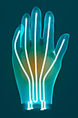 Prosthetic hand,X-ray