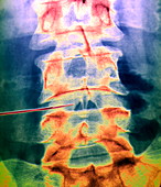 Slipped disc treatment,X-ray