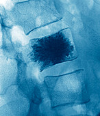 Spinal collapse treatment,X-ray