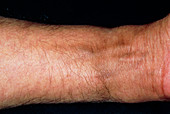 Pigmentation in man's wrist following chemotherapy