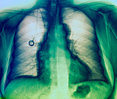Breast cancer chemotherapy,X-ray