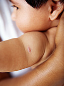 BCG vaccination scar