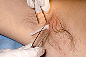 Treatment of an underarm abscess
