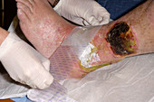 Pyoderma ulcer