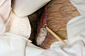 Pilonidal abscess treatment
