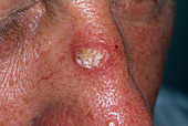 Seborrhoeic wart treatment