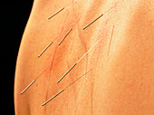 Acupuncture to reduce 'aggressive energy'