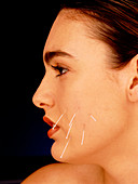Woman with acupuncture needles in cheek
