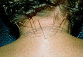 Acupuncture needles in a patient's neck