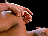 Acupuncture needle being put in patient's shoulder