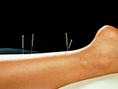 Acupuncture needles in a woman's leg