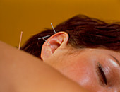 Acupuncture