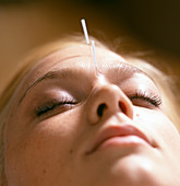 Acupuncture