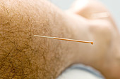 Acupuncture needle