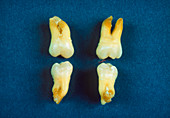 All four wisdom teeth removed