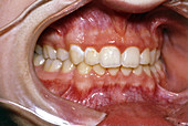 Close-up of teeth after removal of fixed braces
