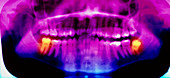 Coloured pan-oral X-ray of an erupted wisdom tooth
