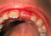 Eruption of upper incisor tooth in 8-year-old boy
