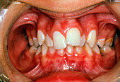 View of malaligned teeth before braces were fitted