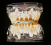 Dental model of an 11 year old child's teeth