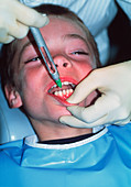 Dental anaesthetic