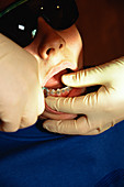 Orthodontic brace removal