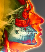 Orthodontic brace X-ray