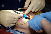 Undescended tooth treatment