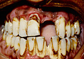 Close-up of mouth reflecting poor oral care