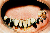 Damaged teeth