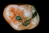 Extracted molar showing 3 amalgam fillings