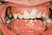 Mouth showing evidence of gingivitis