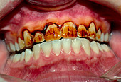 Teeth showing plaque