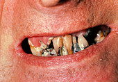 Very poor dental care in a psychiatric patient
