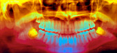 Coloured pan-oral X-ray of impacted wisdom teeth