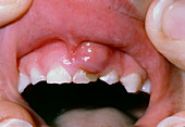 Dental abscess in child