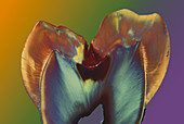 Polarised LM of a molar tooth with decay