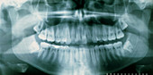 Panoramic dental X-ray of impacted wisdom teeth