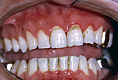 Dental plaque