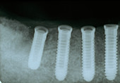 Dental implants,X-ray