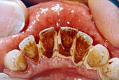 Dental plaque and tartar