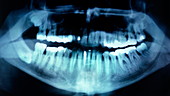 Dental fillings,X-ray