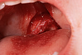 Oral injury