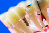 Tooth decay and implants,dental model