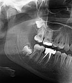 Impacted wisdom teeth,X-ray