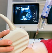 Amniocentesis sampling with needle and ultrasound