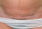 Caesarean section scar,six weeks after the birth