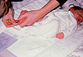 Guthrie test on newborn baby