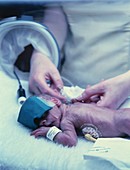 Premature baby undergoing treatment for jaundice