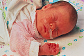 Newborn baby receives oxygen through a nasal tube